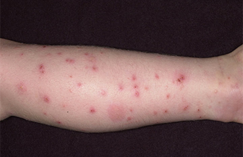 Human leg with multiple red splotches